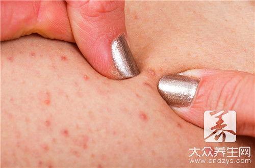 小孩毛囊炎图片,儿童毛囊炎症状图解与护理要点
