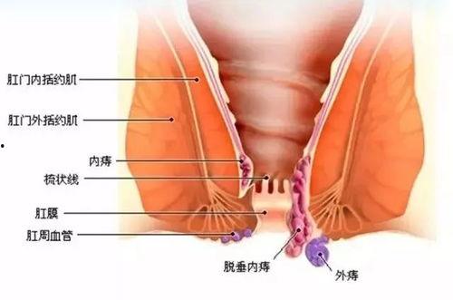 肛门脓包初期图片大全,肛门脓包初期症状图解解析