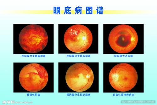 眼底图片,探寻人体健康的隐形窗口