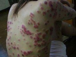 红斑狼疮的图片,揭秘自身免疫性疾病的神秘面纱