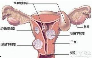 子宫肌瘤可以吃黑瓜,子宫肌瘤患者健康饮食指南