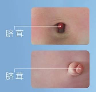 脐茸图片,揭秘新生儿常见皮肤病变的形态与特征
