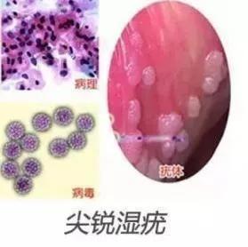 尖锐湿疣早期图片,症状与预防要点