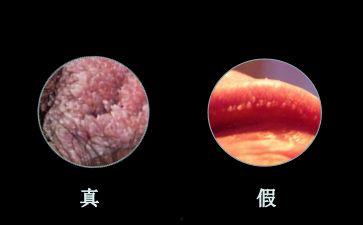 尖锐湿疣早期图片,症状与预防要点