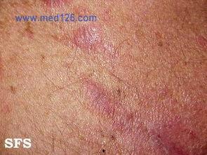 日光疹早期图片,识别与预防