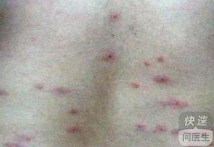 日光疹早期图片,识别与预防