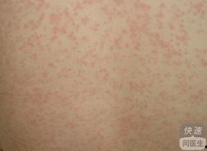 日光疹早期图片,识别与预防